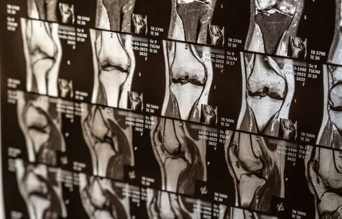 Resonancia magnética de la rodilla